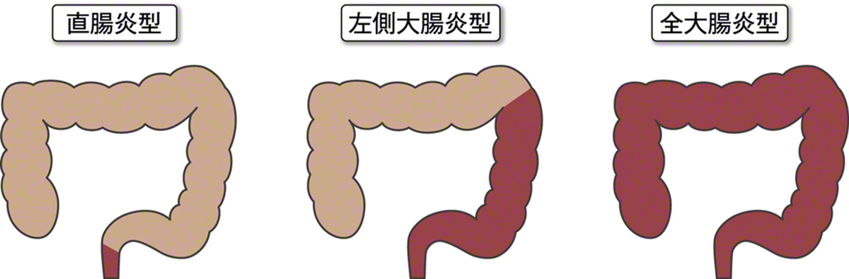 大腸タイプ